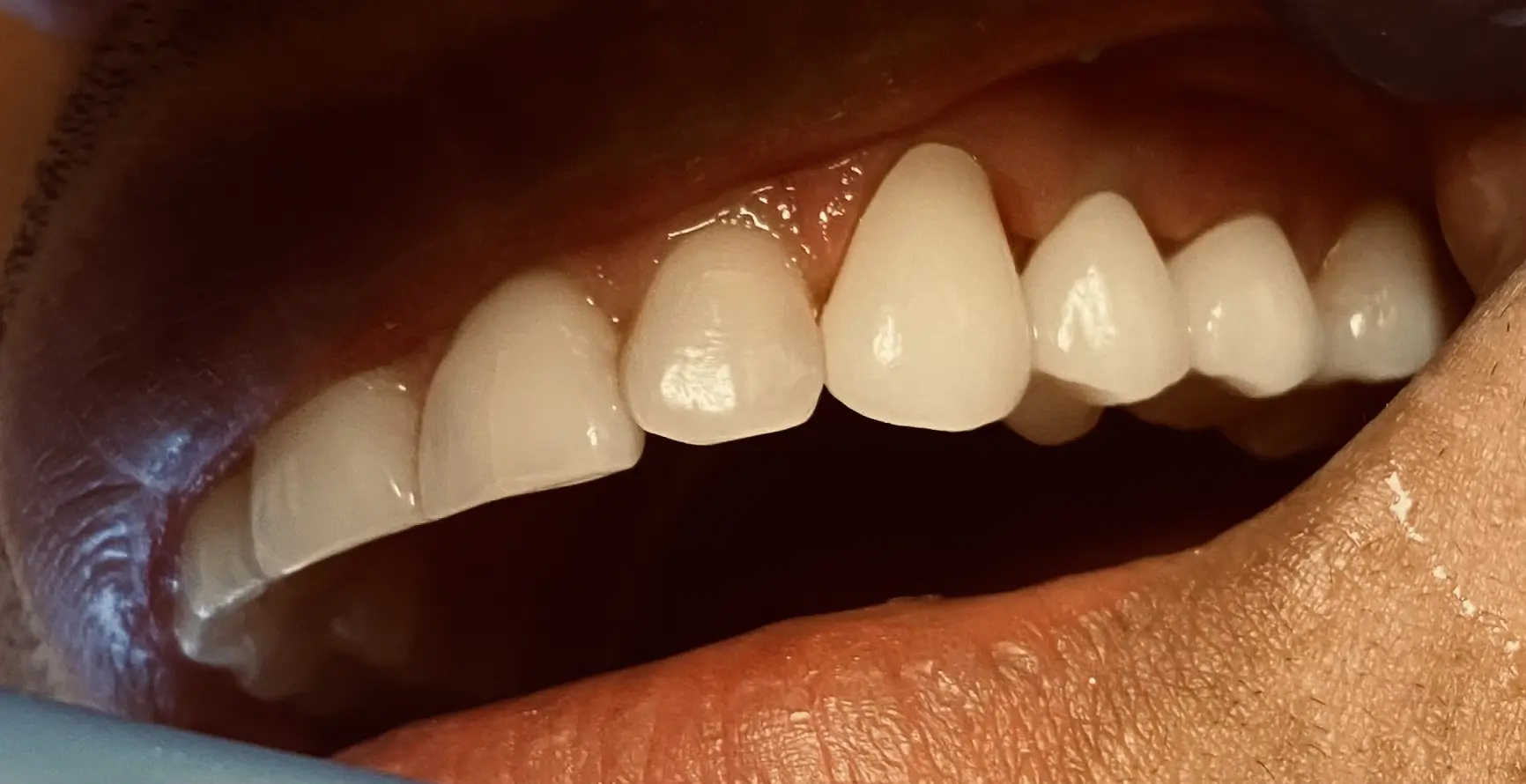 Patient's smile after zirconium bridge tooth replacement