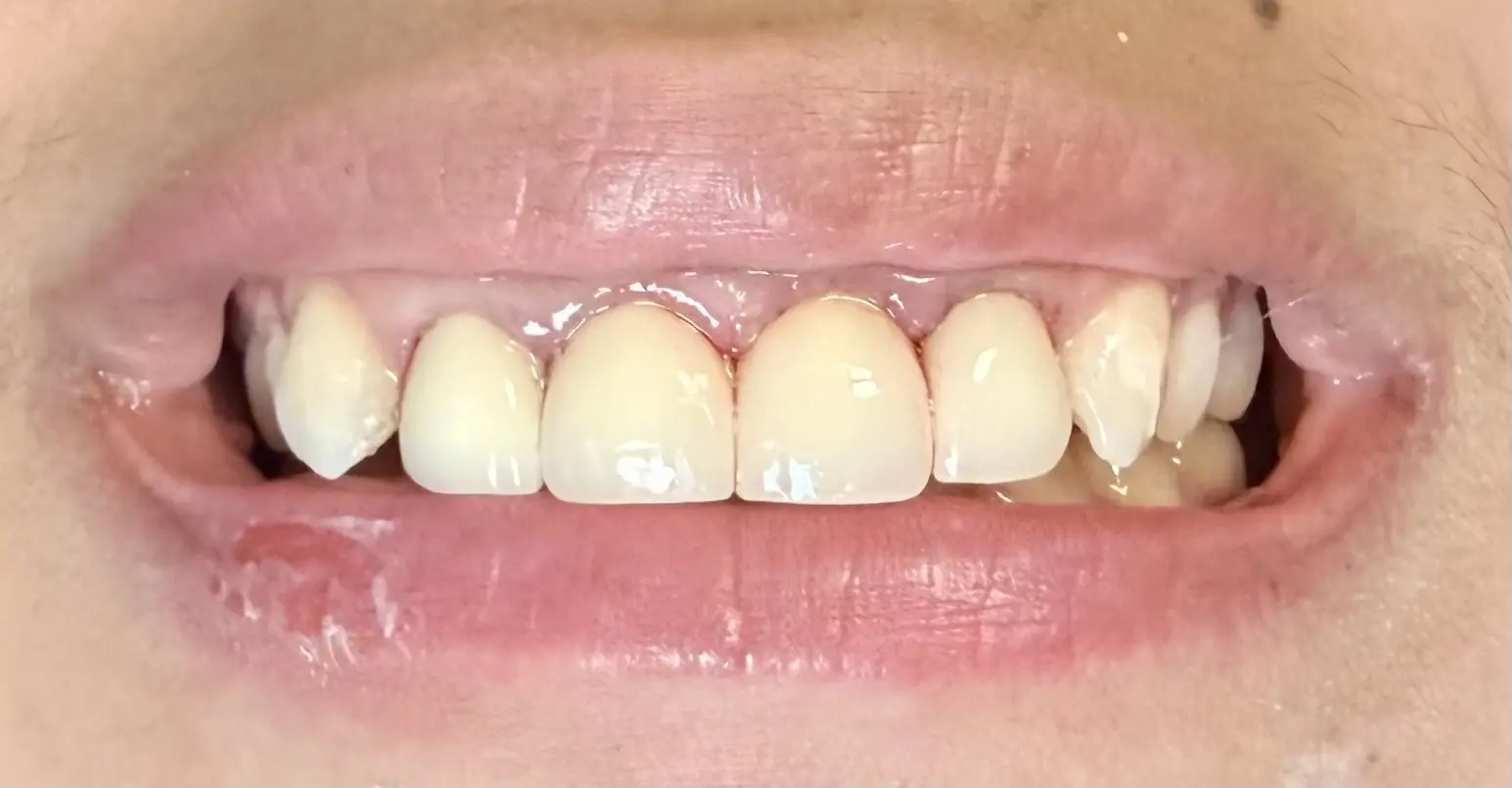 Patient's smile after full coverage zirconium crown treatment