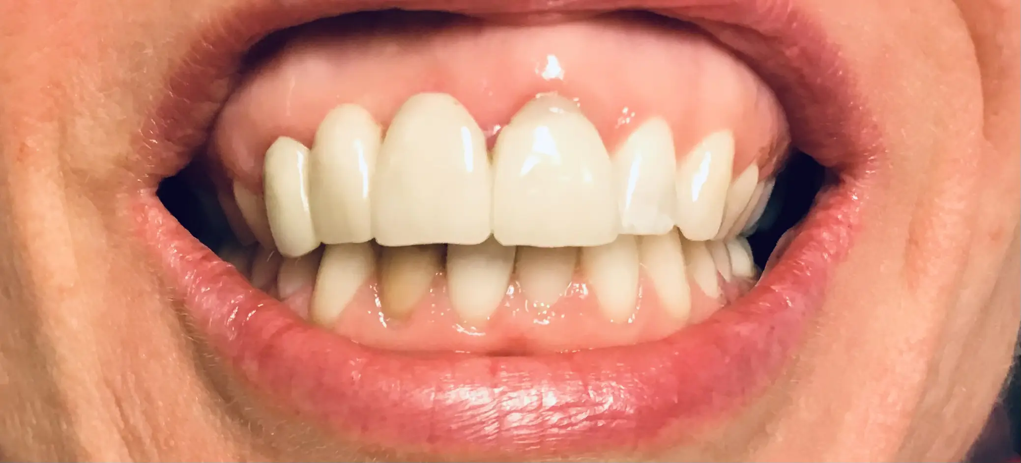 Patient's smile after zirconium bridge tooth replacement